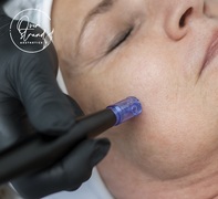 Micro-needling Treatments