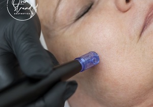 Micro-needling Treatments