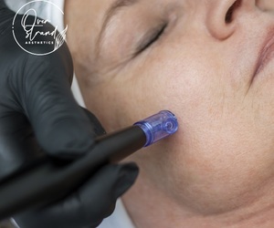 Micro-needling Treatments