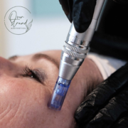 Microneedling
