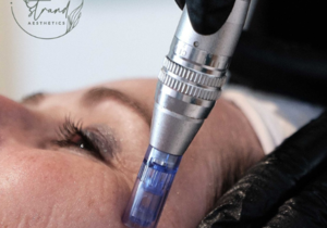 Microneedling