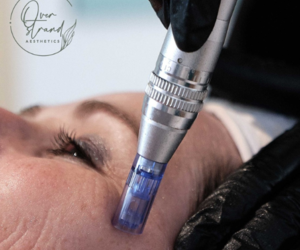 Microneedling