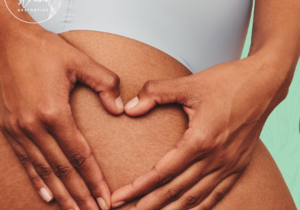 Stretch Mark Solutions