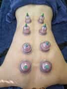 Cupping