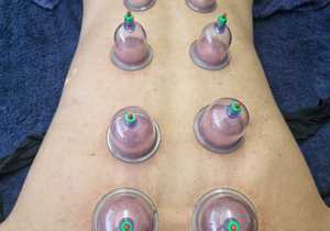 Cupping