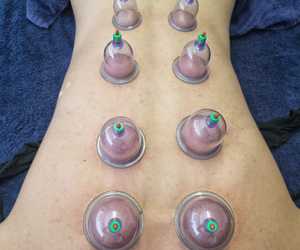 Cupping