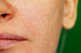 Understanding Pigmentation and Effective Treatment Options