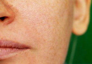 Understanding Pigmentation and Effective Treatment Options