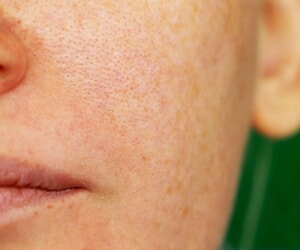 Understanding Pigmentation and Effective Treatment Options