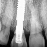 X-ray of immediately placed implant with extracted tooth's crown