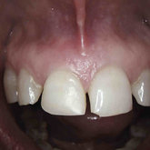 After 1 week of healing