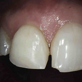 Healing after 1 month