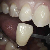 Taking the correct shade of the tooth