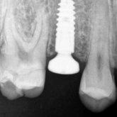 Healing abutment placed on implant