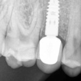 Implant with crown