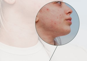 Breakouts Don’t Mean You Have to Avoid Facials