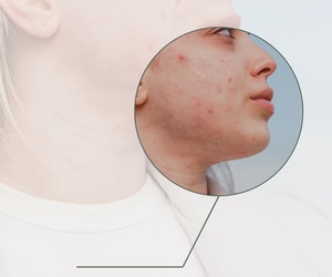 Breakouts Don’t Mean You Have to Avoid Facials