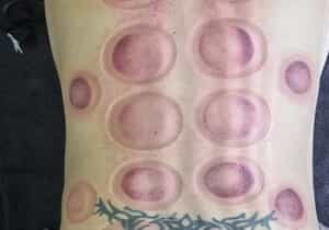 Cupping