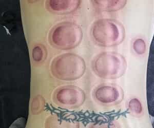 Cupping