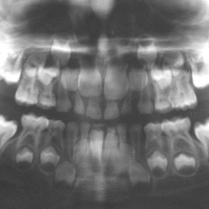 PAN of childs mouth showing primary and permanent teeth