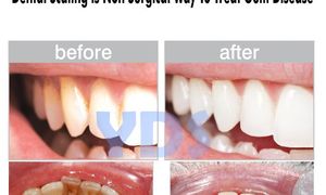 SCALING AND POLISHING