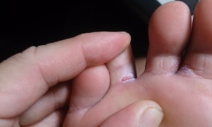 Do you have athlete's foot?