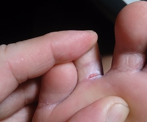 Do you have athlete's foot?