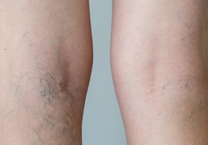 How to prevent varicose and spider veins