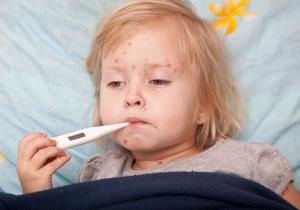 Know the risks of chicken pox