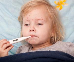 Know the risks of chicken pox