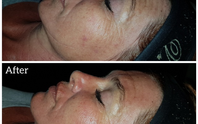 Napier - Eagles Rest Spa - Micro needling