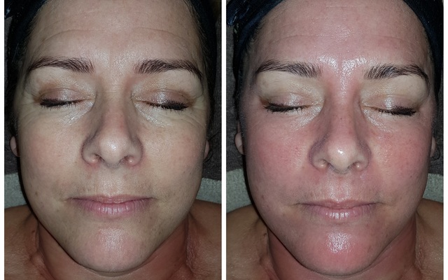 Napier - Eagles Rest Spa - Micro needling