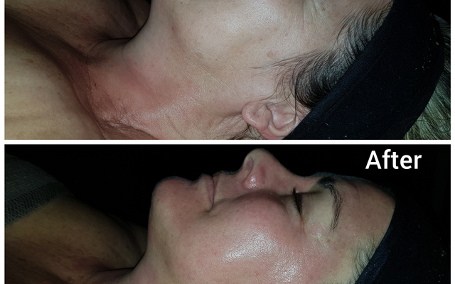 Napier - Eagles Rest Spa - Micro needling