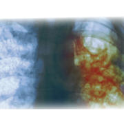 What To Do If You Have Been Exposed To TB