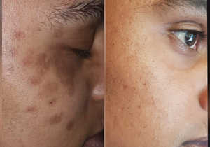 Skin Pigmentation