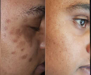 Skin Pigmentation