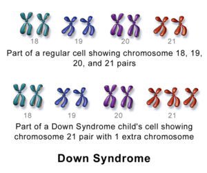 Wat is Downsindroom?